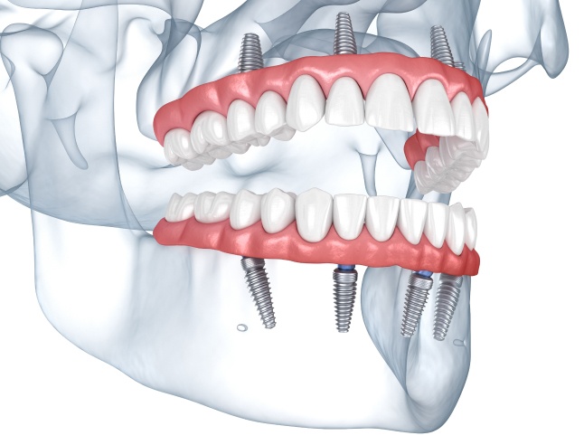 Diagram of implant placement