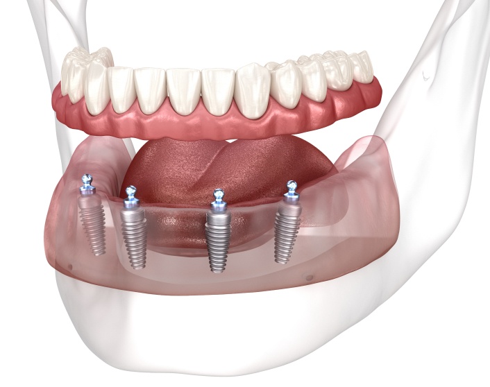 Diagram of implant attachment